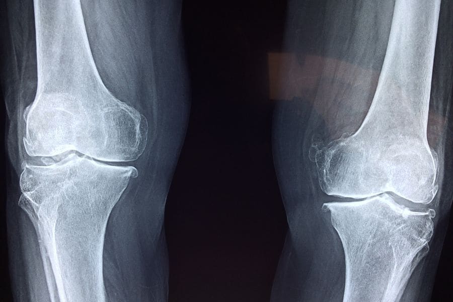 bone density x-ray